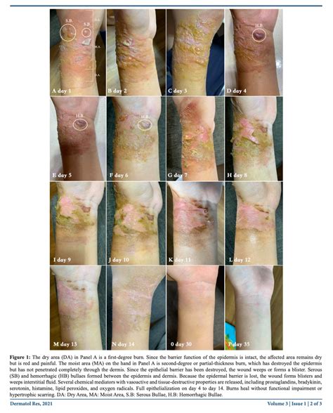 Scar formation. . 2nd degree burn healing stages